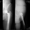 img Prothèse totale de hanche gauche cimentée