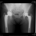 img Radiographie bassin de face prothese totale de hanche bilaterale